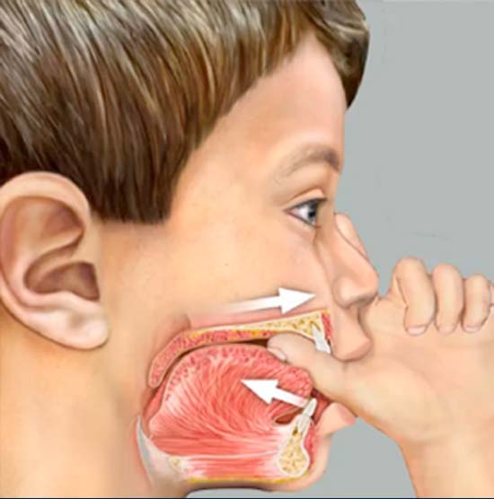 odontologia miofuncional, myobrace