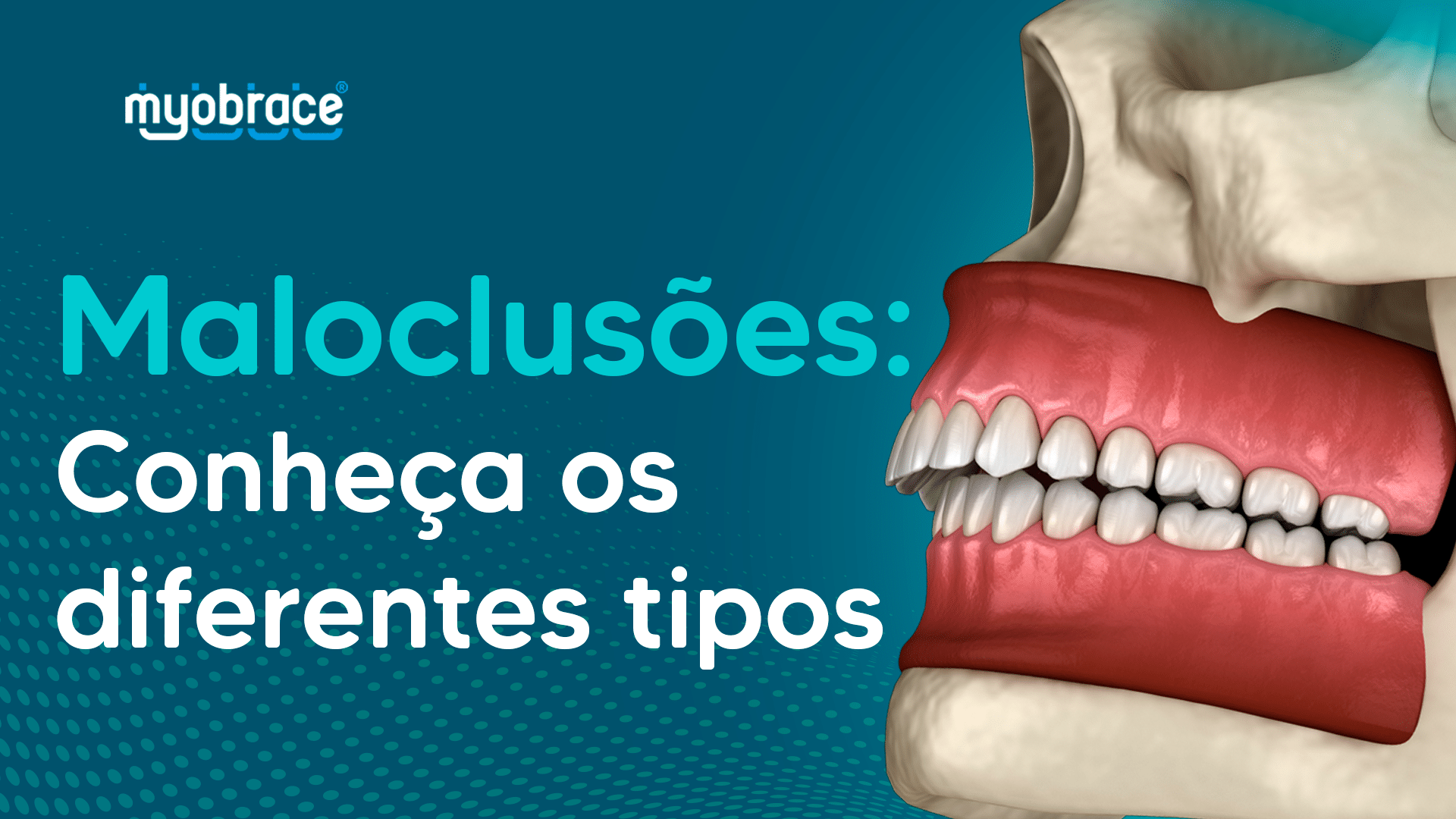 má oclusão dentária, maloclusões, má oclusão, tipos de má oclusão, tipos de maloclusões, maloclusões dentarias, aparelhos miofuncionais, myobrace, sistema myobrace, odontologia miofuncional, quais tipos de maloclusões
