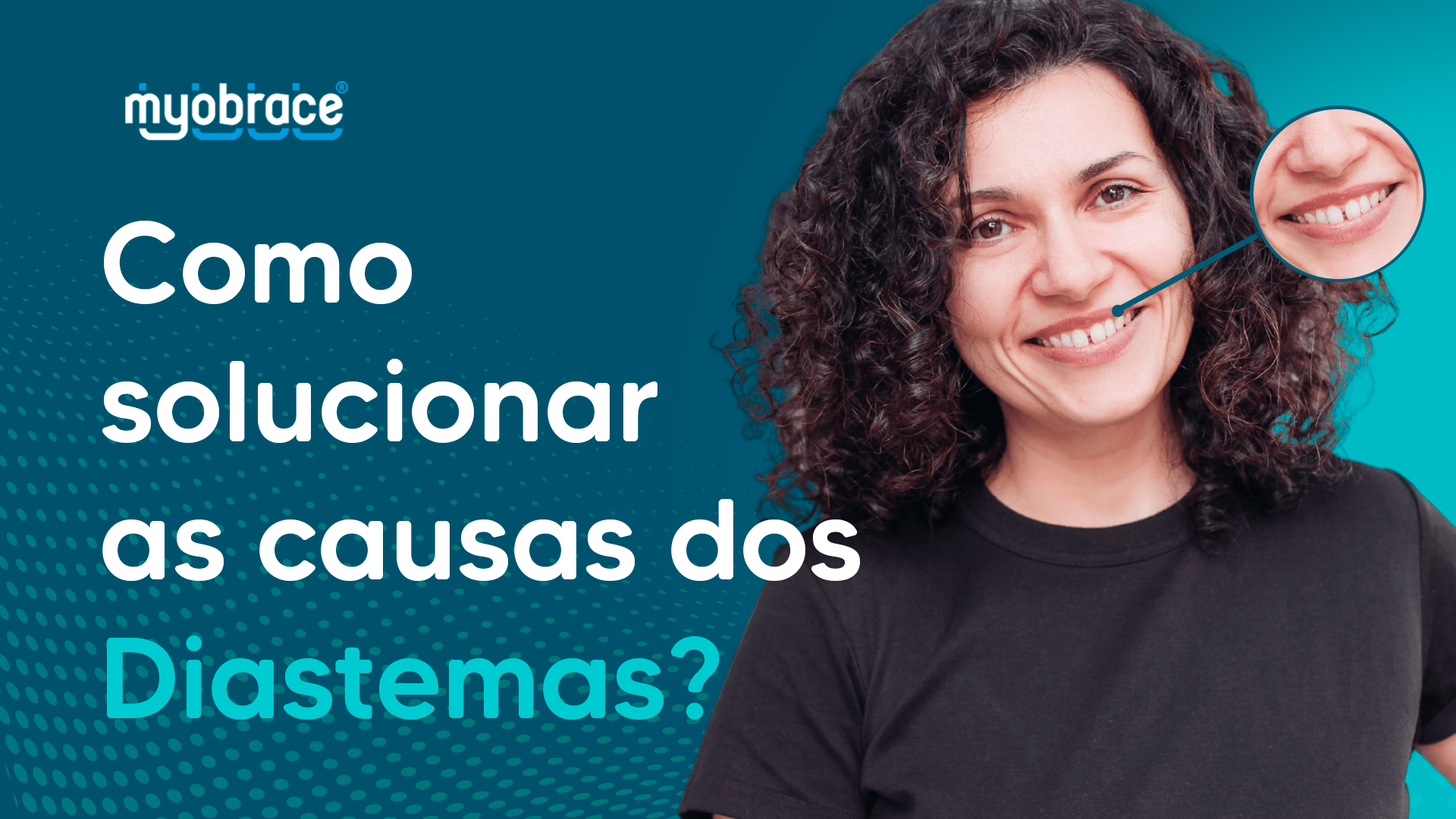 diastema, diastemas dentários, aparelho diastema, diastema infantil, diastema dental, causas dos diastemas, diastemas generalizados, ortodontia diastema, myobrace, sistema myobrace, odontologia miofuncional, dentes separados